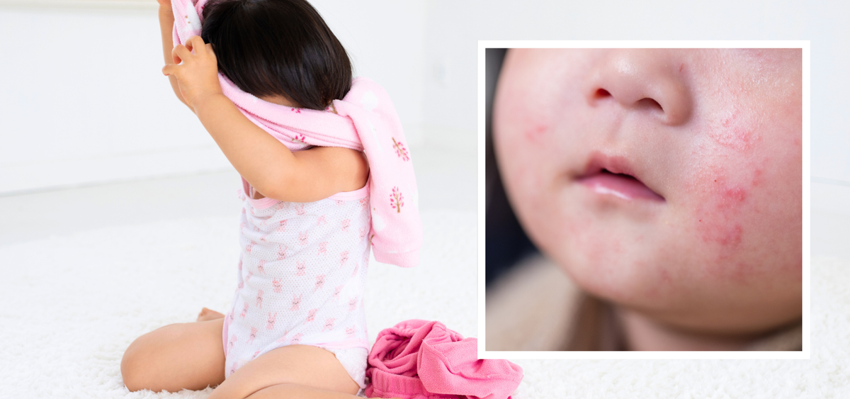 Why Do Kids Get Rashes from Clothes? What Parents Should Know. – Tofu